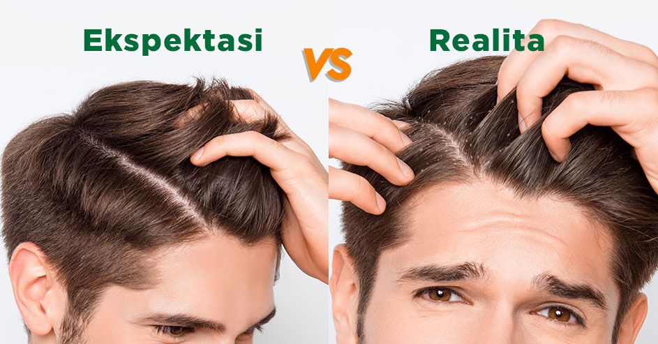 Bebas Ketombe Vs. Hujan Ketombe