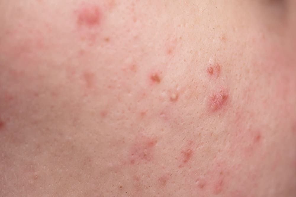 Perbedaan Dark Spot dengan Bekas Luka & Jerawat